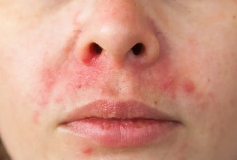 درماتیت صورت - کرج