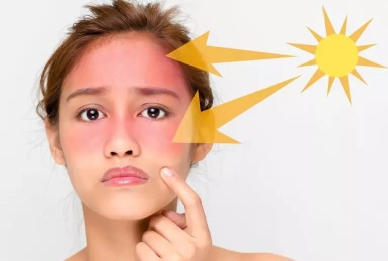 دکتر درمان آفتاب سوختگی - تهران